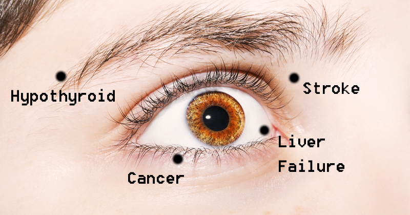 8 Things Your Eyes Are Trying To Tell You About Your Health